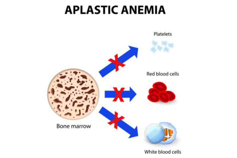 Ilustrasi penyakit anemia aplastik (kompas)